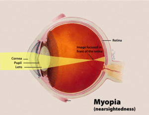 Eye problem in Nigeria