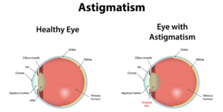 Eye problem in Nigeria