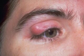 Chalazion (Eyelid Cyst) A chalazion (also called a meibomian cyst, tarsal cyst, or conjunctival granuloma) is the inflammation of a small cystic gland in the eyelid. The gland opening becomes clogged and the gland swells. Chalazions are treated with warm compresses, though in rare cases they may require antibiotics. If the chalazion becomes severe, causes changes in vision, or is persistent, it may be removed surgically. Corneal Ulcer A corneal ulcer is a common eye condition. It refers to small crater (ulcer) on the front part of the eye, usually following an infection. Bacteria, viruses, or fungus can cause a corneal ulcer. People who wear contact lenses are at higher risk for corneal ulcers. That’s because infectious agents may get trapped behind a lens. People deficient in vitamin A are particularly vulnerable to corneal ulcers. Symptoms of a corneal ulcer include: • pain, • intense redness, • feeling as if the eye is scratched or something is in the eye, • sensitivity to light, and • blurry vision. If you suspect a corneal ulcer or have the symptoms of a corneal ulcer and wear contact lenses, see your ophthalmologist immediately. High potency antibiotics and pain medications are the treatments for this condition. Diabetic Retinopathy People with diabetes often have problems with their blood vessels throughout their bodies and the eye is no exception. Diabetes can come with complications, such as diabetic retinopathy. This eye problem affects the blood vessels in the back of the eye, on the retina. There are two types of diabetic retinopathy: • Nonproliferative retinopathy, the less severe type in which there may be bleeding in the retina and leakage of blood or serum causing a "wet retina." • Proliferative retinopathy, a more severe type where new abnormal blood vessels grow on the retina. These vessels may bleed into the vitreous (the clear jelly in the center of the eye) and cause visual problems. Treatment involves laser surgery but damage may be permanent. The best way to prevent diabetic retinopathy is with strict glucose control and a healthy lifestyle (weight loss, dietary restrictions, and exercise). Diabetes and Dry Eyes Multiple studies have shown a relationship between diabetes and dry eyes. What’s more, studies suggest that the higher your blood sugar levels spike, the more likely you are to have dry eyes. This eye condition is mainly treated with eye drops, blocking tear ducts, or medicine that increases how much your eyes tear. Crossed Eyes (Strabismus) Crossed eyes (strabismus) is an eye problem involving a misalignment of your eyes. In other words, your eyes do not look in the same direction as they should. One eye may track differently than the other, causing a disjointed appearance. Young children born with this disorder may develop decreased vision in one eye (amblyopia, also known as “lazy eye.”). Treatment for strabismus involves using an eye patch on the stronger eye, eye exercises, and possibly surgery. Floaters Floaters are caused by aging changes in the vitreous jelly of the eye. They are a common consequence of aging. If you develop multiple floaters, or floaters associated with pain, get checked by your ophthalmologist. In general floaters do not cause blindness and are mostly harmless. There is no definitive treatment for floaters, as most will fade or become less noticeable over time. Farsightedness (Hyperopia) Farsightedness (hyperopia) is difficulty focusing on objects that are close. It is very common and the incidence increases with age. It is caused by an abnormally flat cornea that does not allow light to sharply focus on the retina. Glasses, contact lenses, or surgery may be used to correct hyperopia.