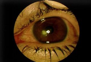 eye_diseases_and_cond_s14_corneal_ulcer