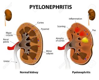 symptoms of kidney diseases