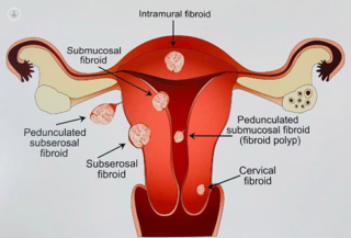 causes of fibroid