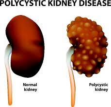 symptoms of kidney diseases